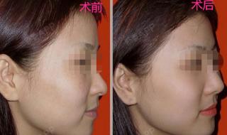 光子嫩肤祛斑多少钱